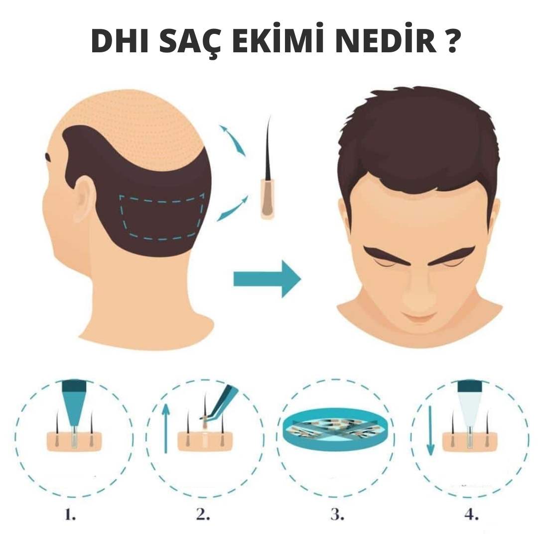 DHI Saç Ekimi Nedir ? Nasıl Yapılır ?