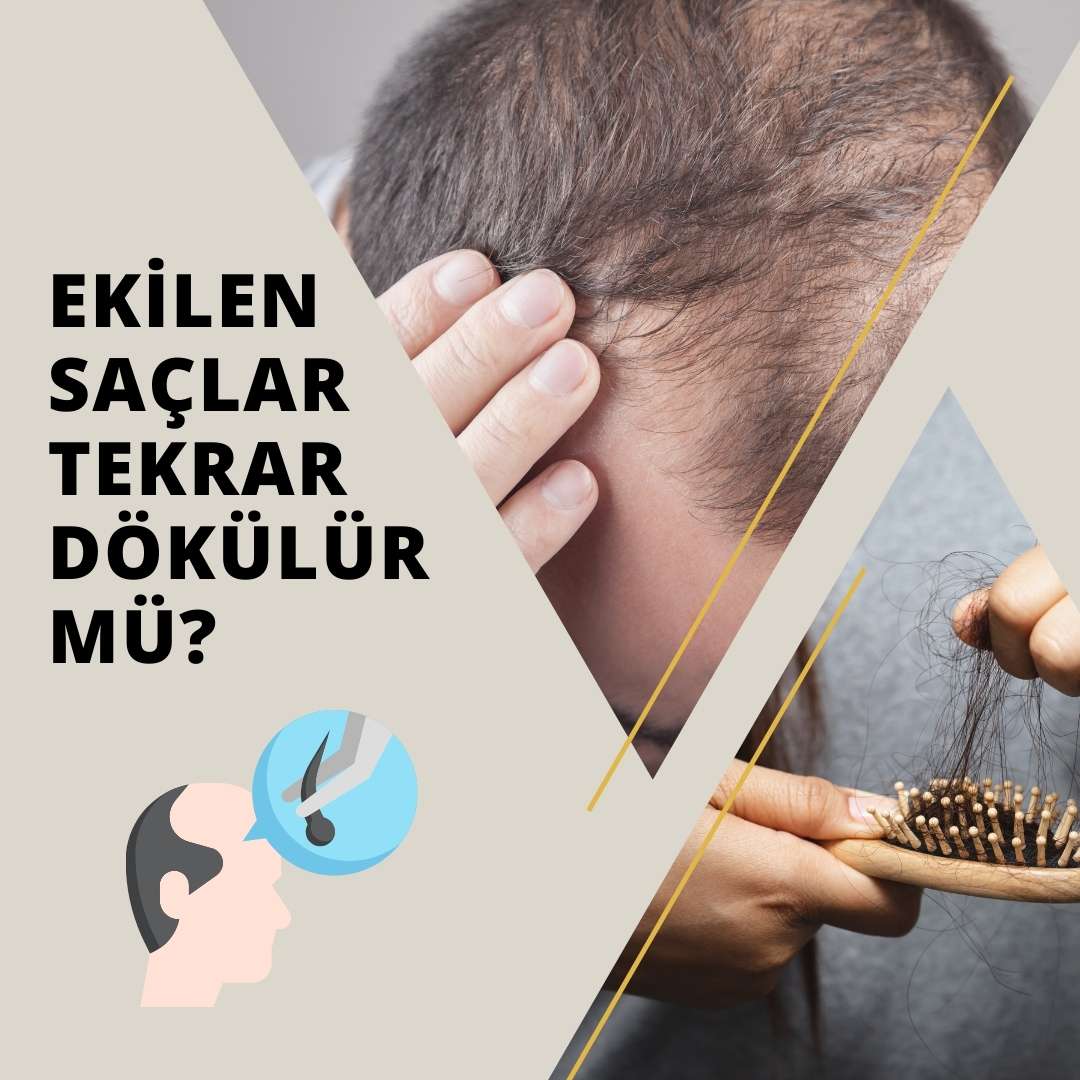 Ekilen Saçlar Tekrar Dökülür mü?