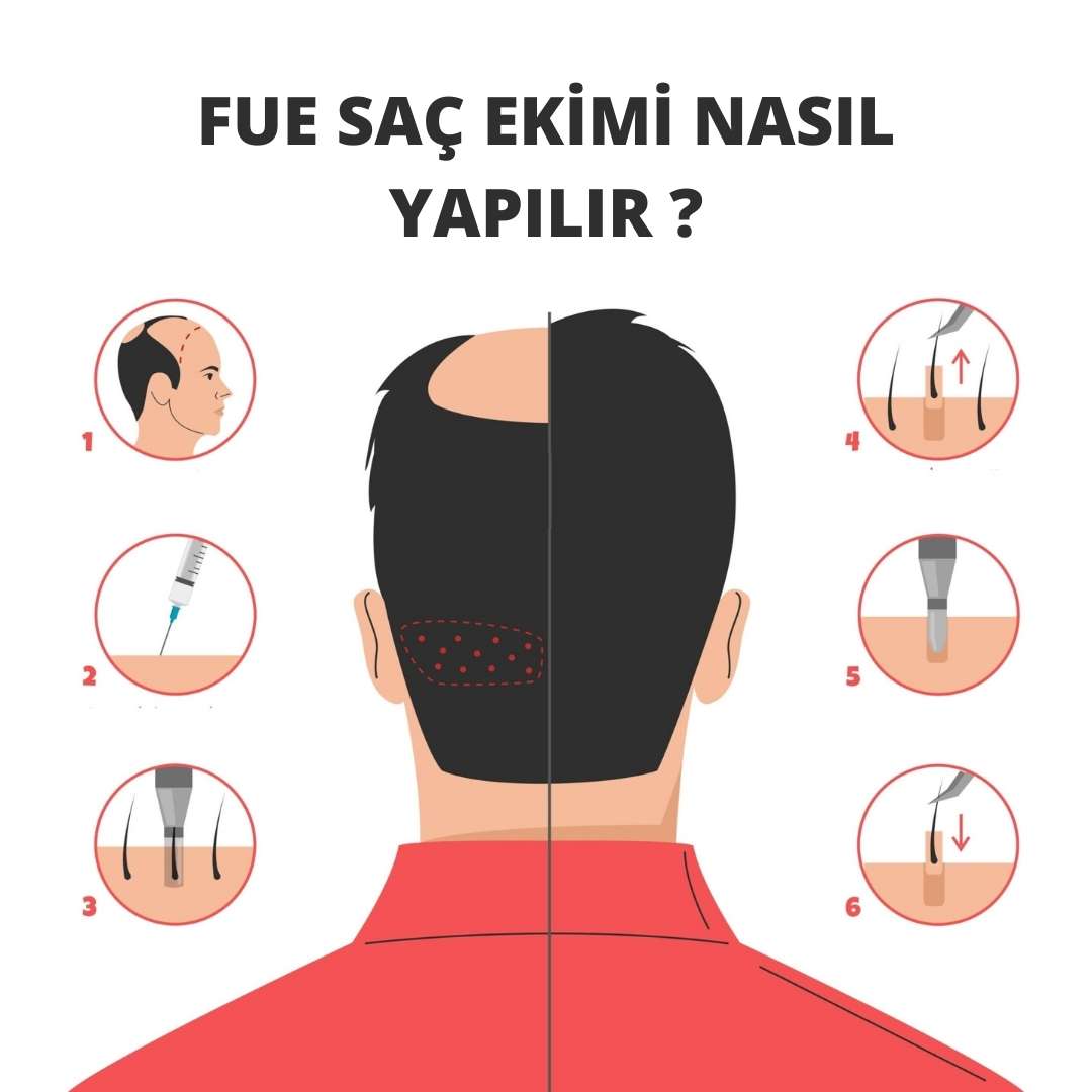 FUE Saç Ekimi Nasıl Yapılır ?