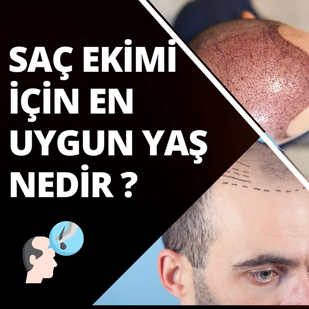 Saç Ekimi İçin En Uygun Yaş