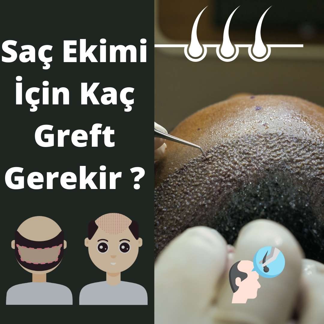 Saç Ektirme İçin Kaç Greft Gerekir ?