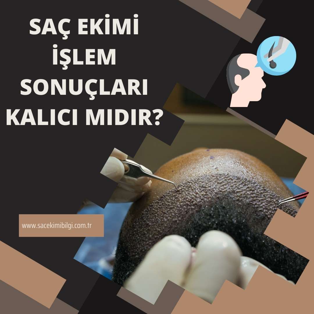 Saç Ekimi İşlem Sonuçları Kalıcı Mıdır?