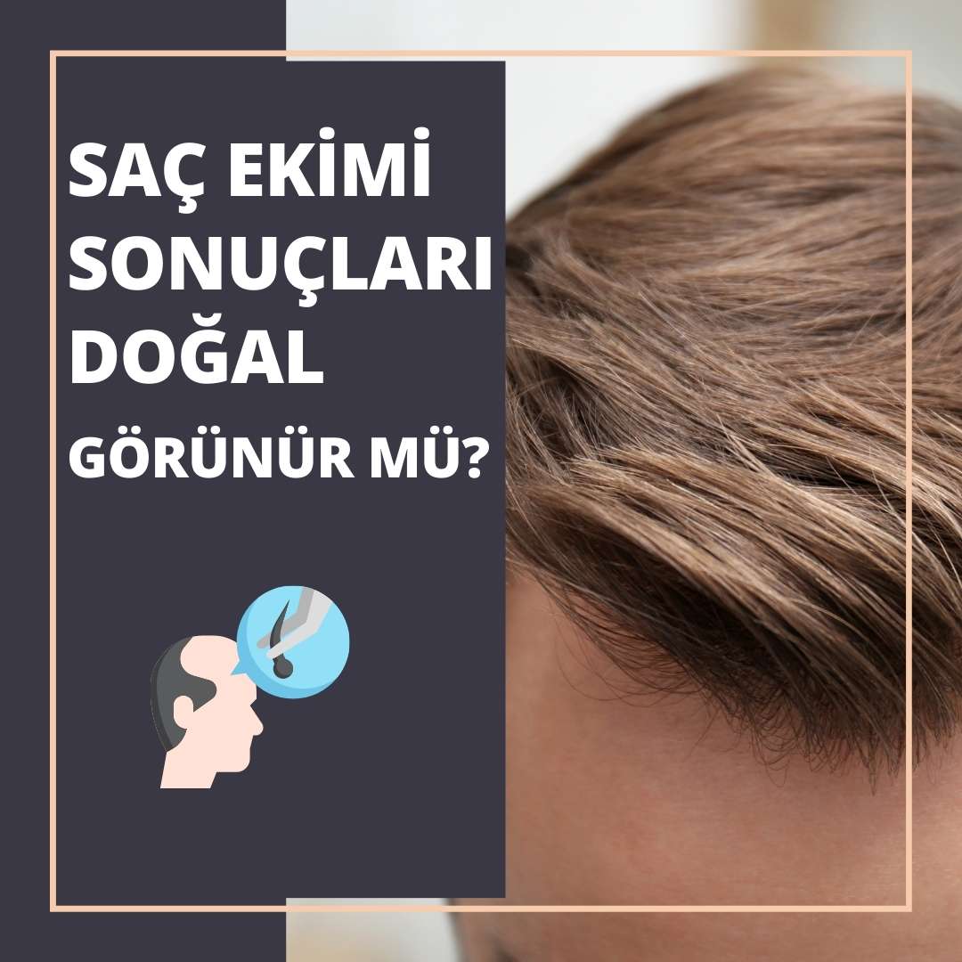 Saç Ekimi Sonuçları Doğal Görünür mü?