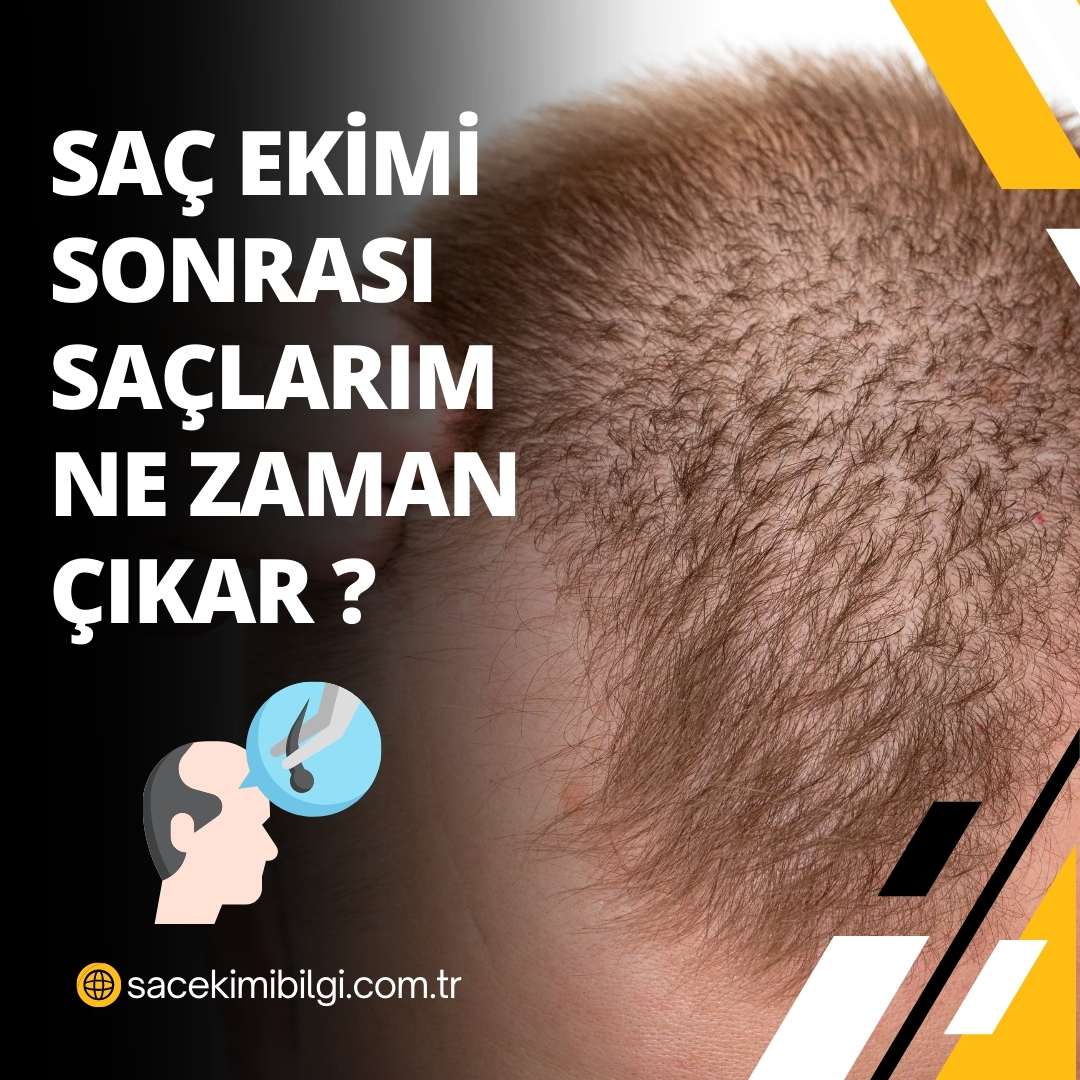 Saç Ekiminden Sonra Saçlarım Ne Zaman Çıkar ?