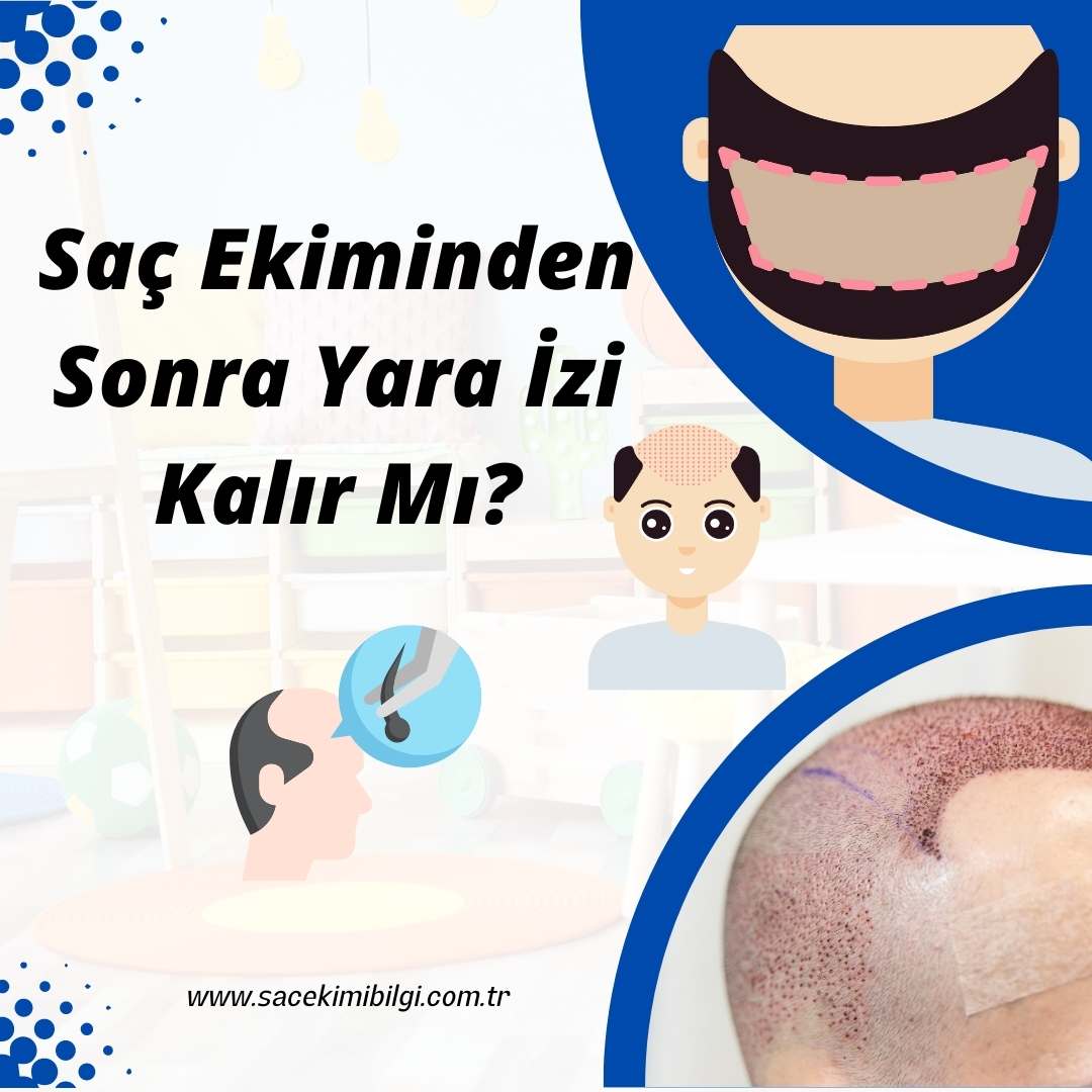 Saç Ekiminden Sonra Yara İzi Kalır Mı?