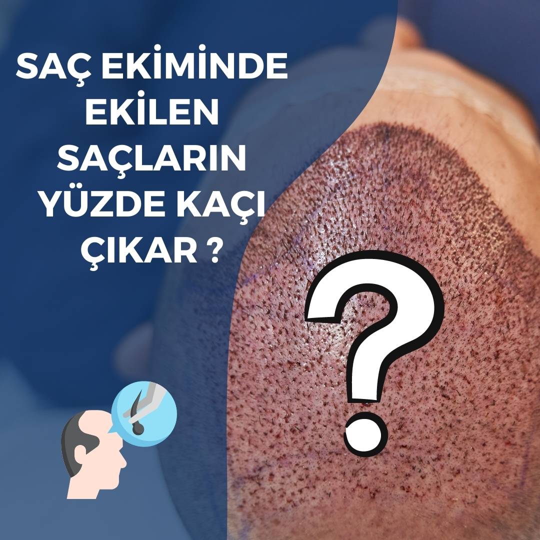 Ekilen Saçların Çıkma Oranı Yüzde Kaçtır?