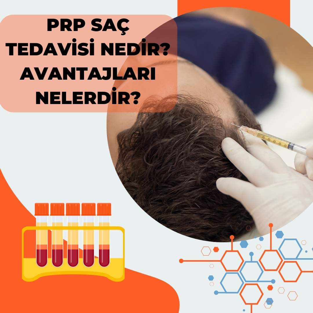 PRP Saç Tedavisi Nedir ? Avantajları Nelerdir ?