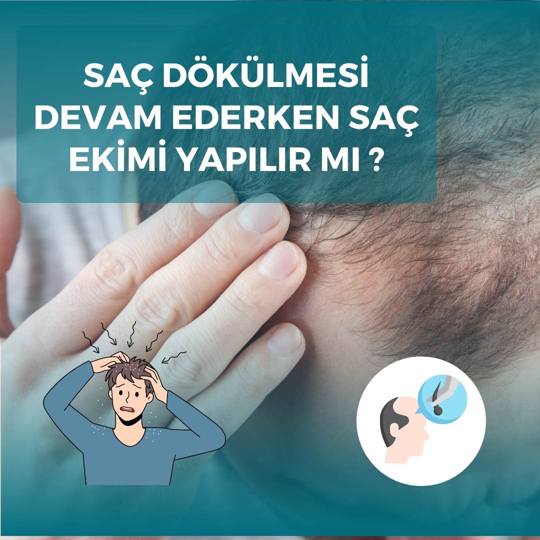 Saç Dökülmesi Devam Ederken Saç Ekimi Yapılır Mı?