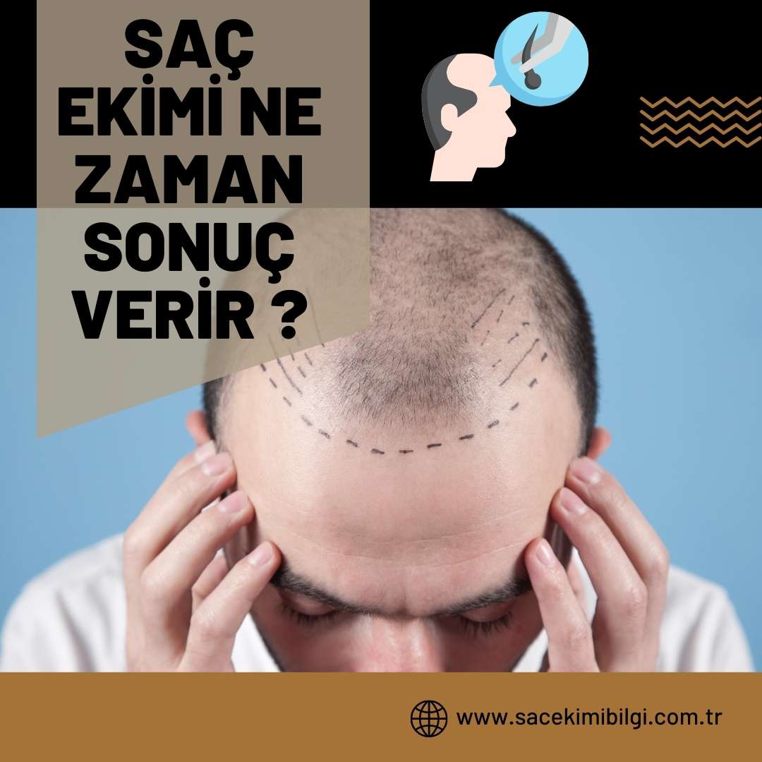 Saç Ekimi Ne Zaman Sonuç Verir ?