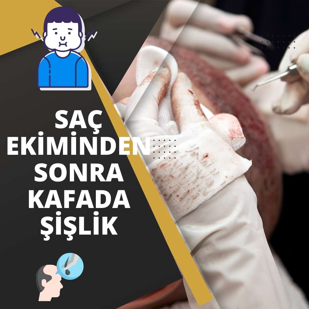 Saç Ekiminden Sonra Kafada Şişlik