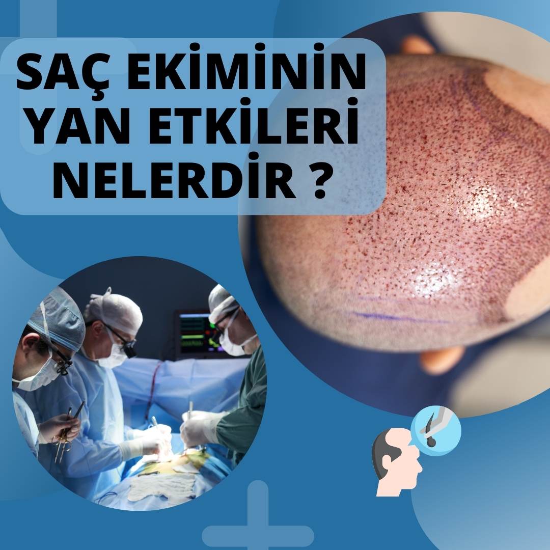 Saç Ekiminin Yan Etkileri Nelerdir ?