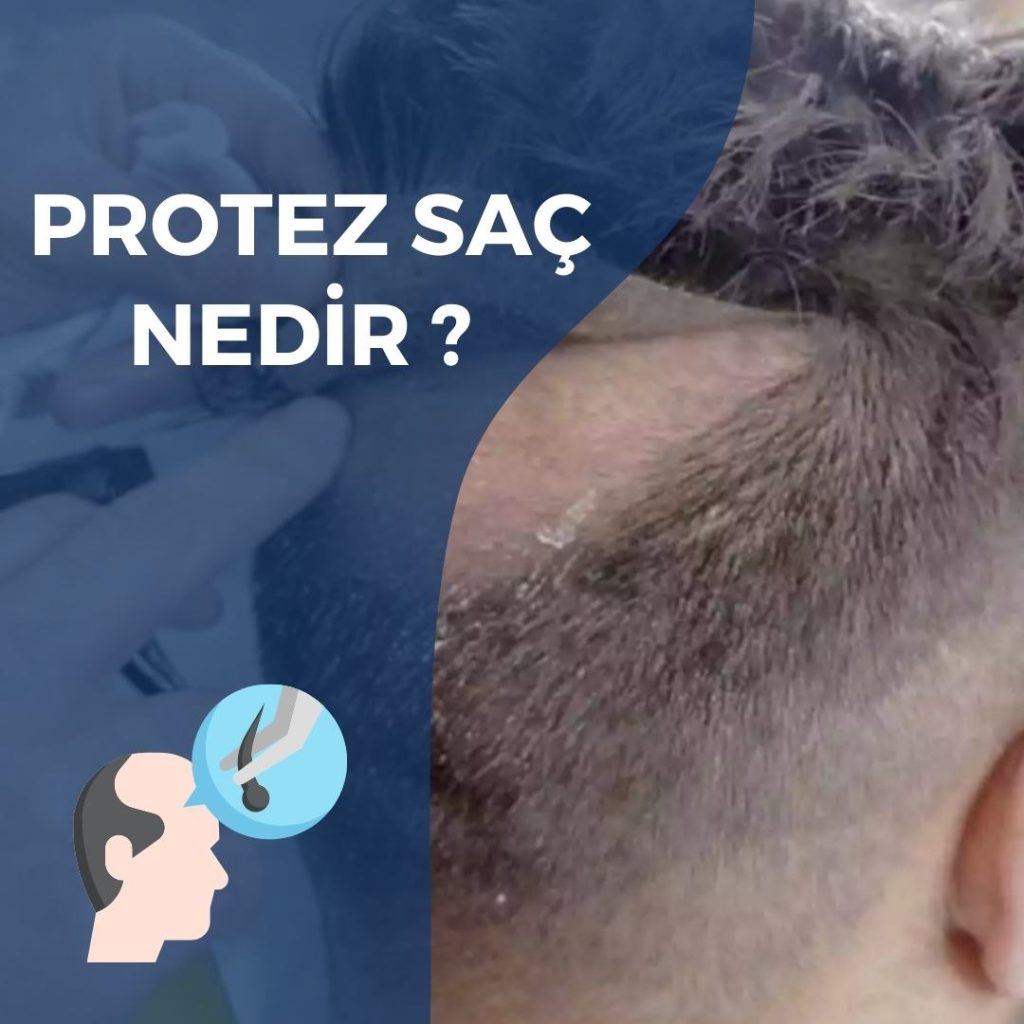 Protez Saç Nedir ? Avantajları ve Fiyatları