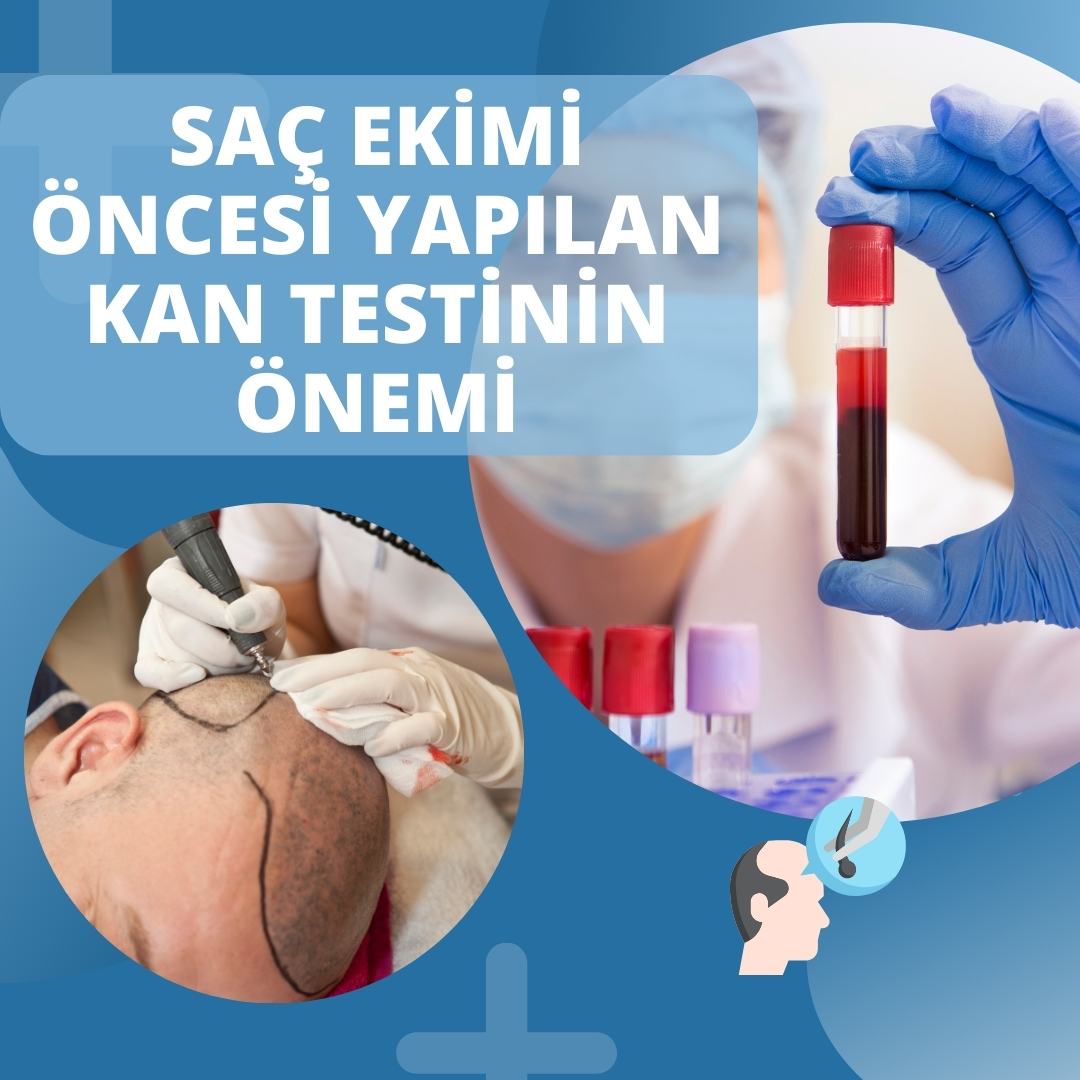 Saç Ekimi Öncesi Yapılan Kan Testinin Önemi