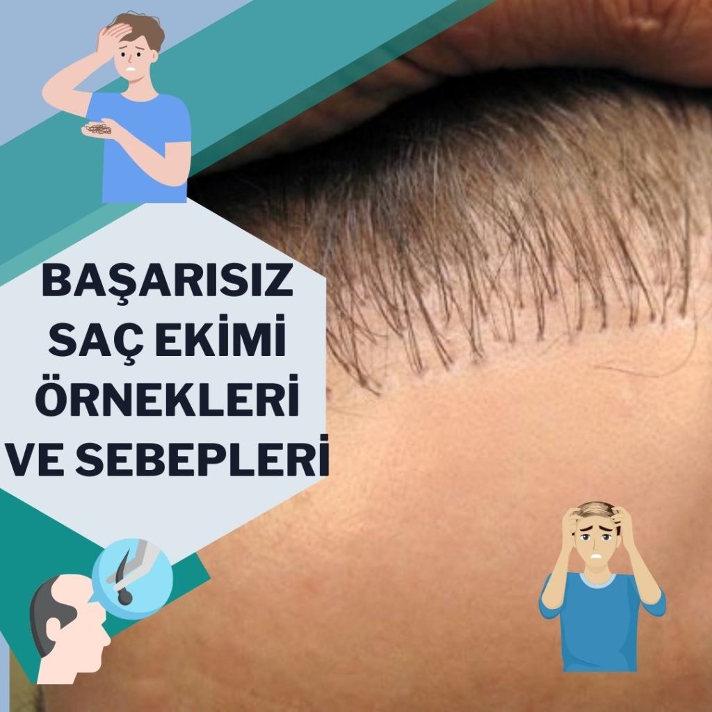 Başarısız Saç Ekimi Örnekleri ve Sebepleri Nelerdir?