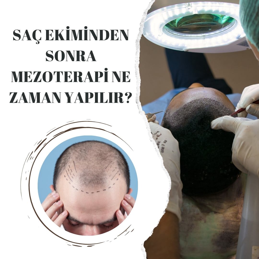 Saç Ekiminden Sonra Mezoterapi Yapılır mı?