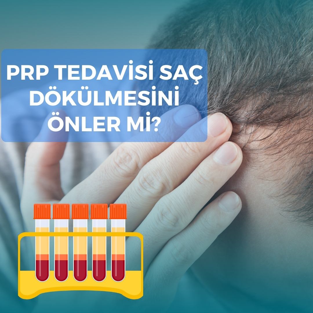 PRP Tedavisi Saç Dökülmesini Önler mi?