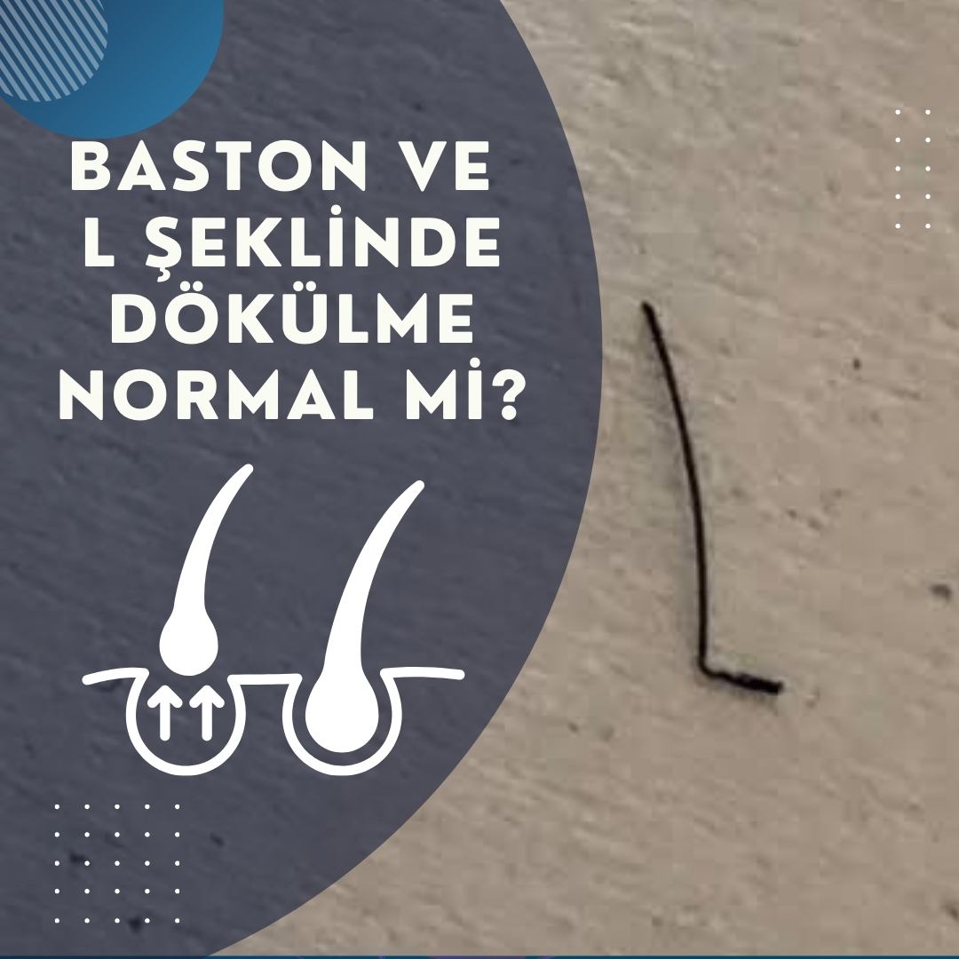 Baston Şeklinde ve L Şeklinde Dökülme Normal mi?