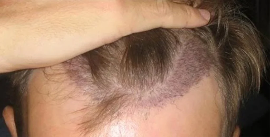 Saç Ekiminde Tıraş Mutlaka Gerekli mi?