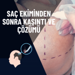 Saç Ekimi Sonrası Kaşıntı ve Çözümü