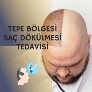 Tepe Bölgesi Saç Dökülmesi Tedavisi