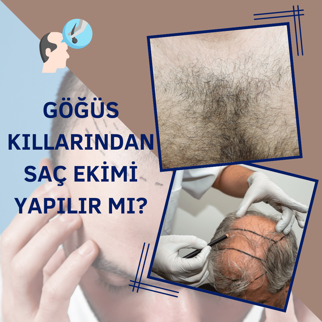 Göğüs Kıllarından Saç Ekimi