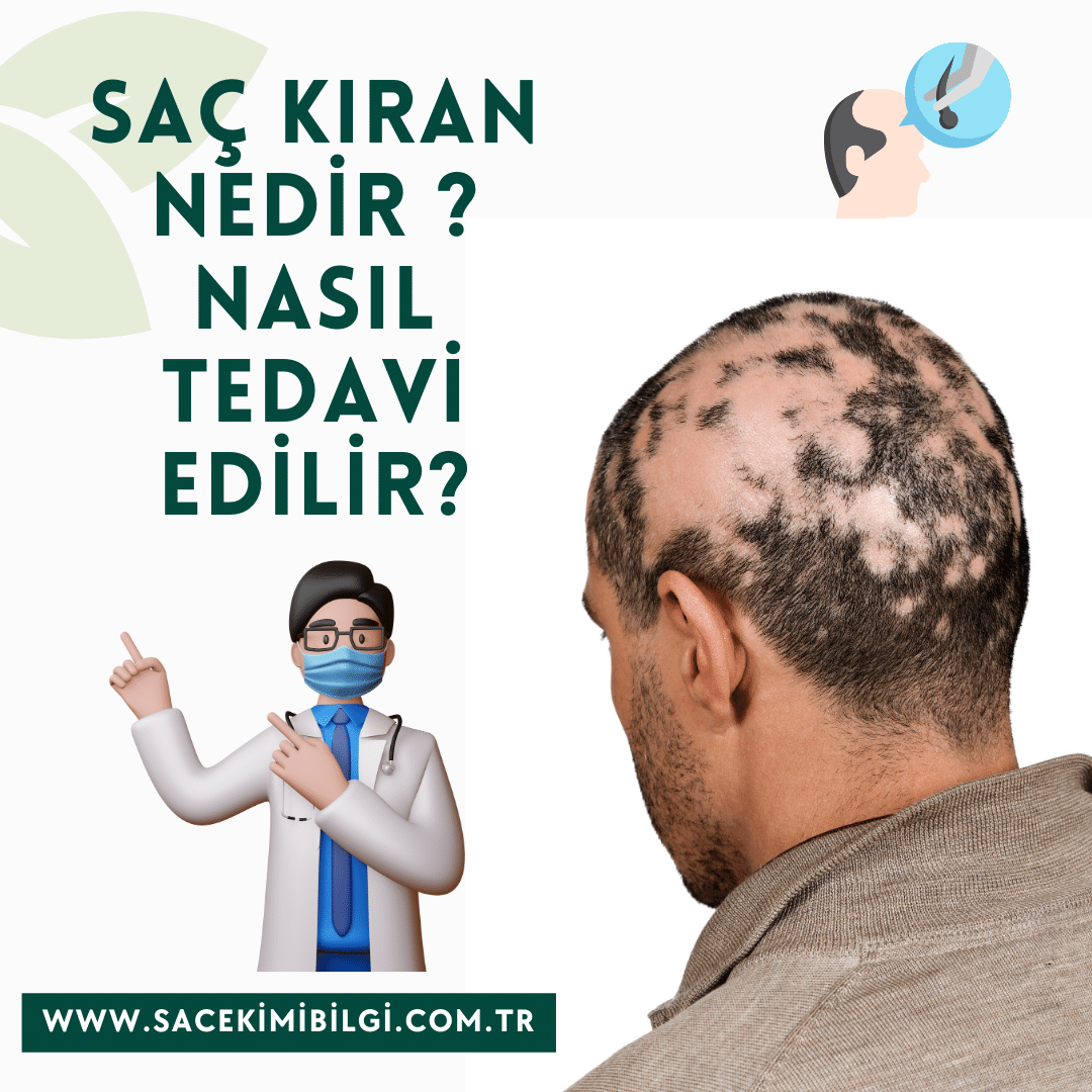 Saçkıran (Alopesi Areata) Nedir ? Tedavisi Nasıl Yapılır?