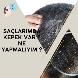 Saçlarımda Kepek Var? Nasıl Tedavi Edebilirim?