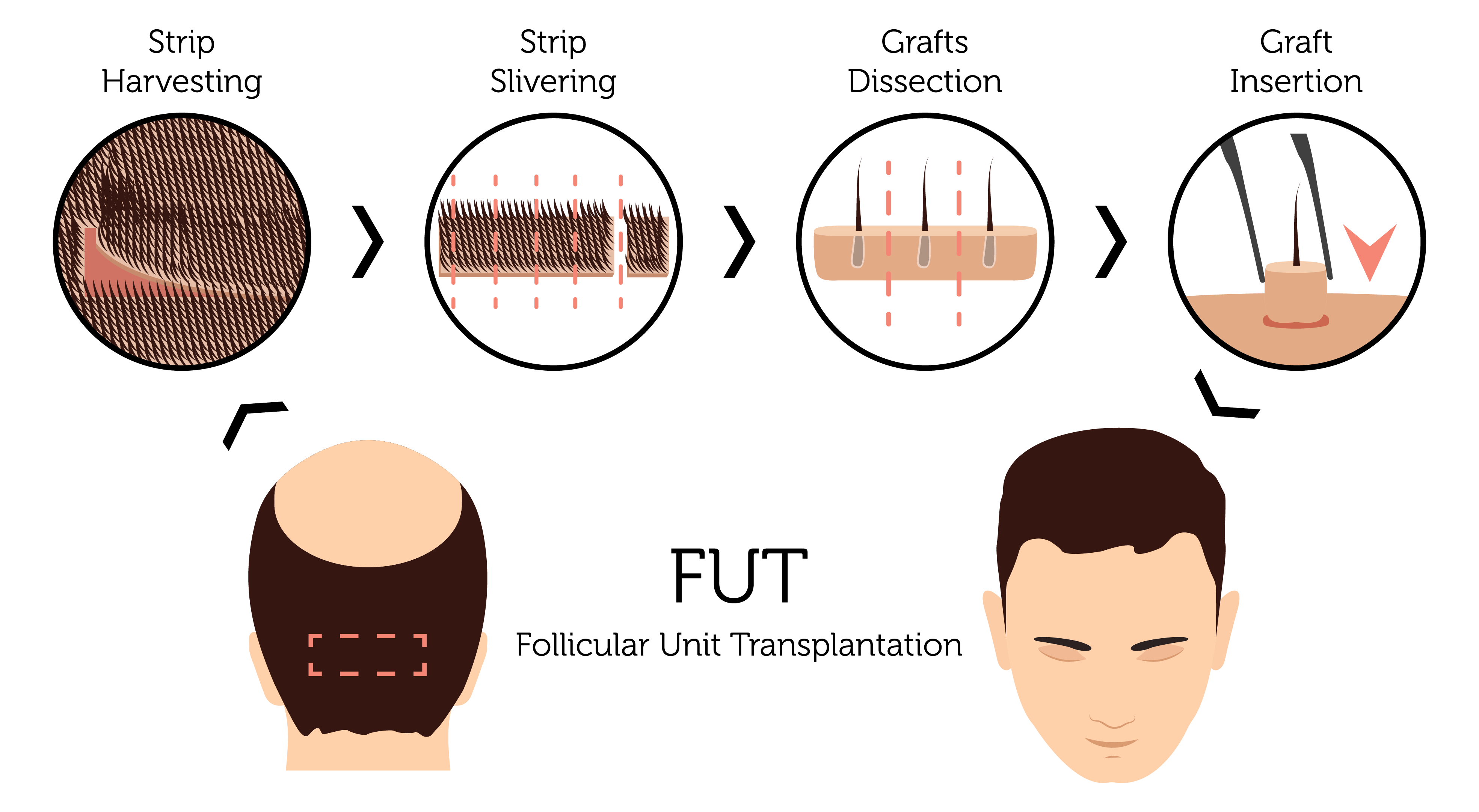 Saç Ekimi İçin Doğru Doktoru Nasıl Seçerim?